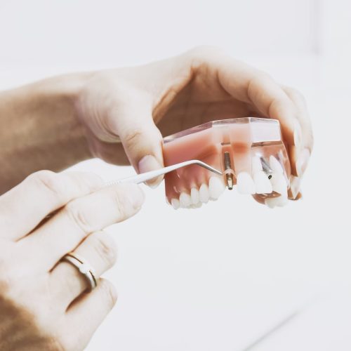 IMPLANTES_1